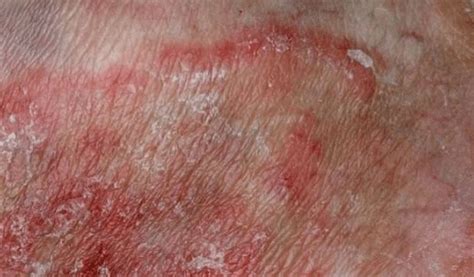 Como Curar Micose na Virilha (Tinea Cruris): 13。